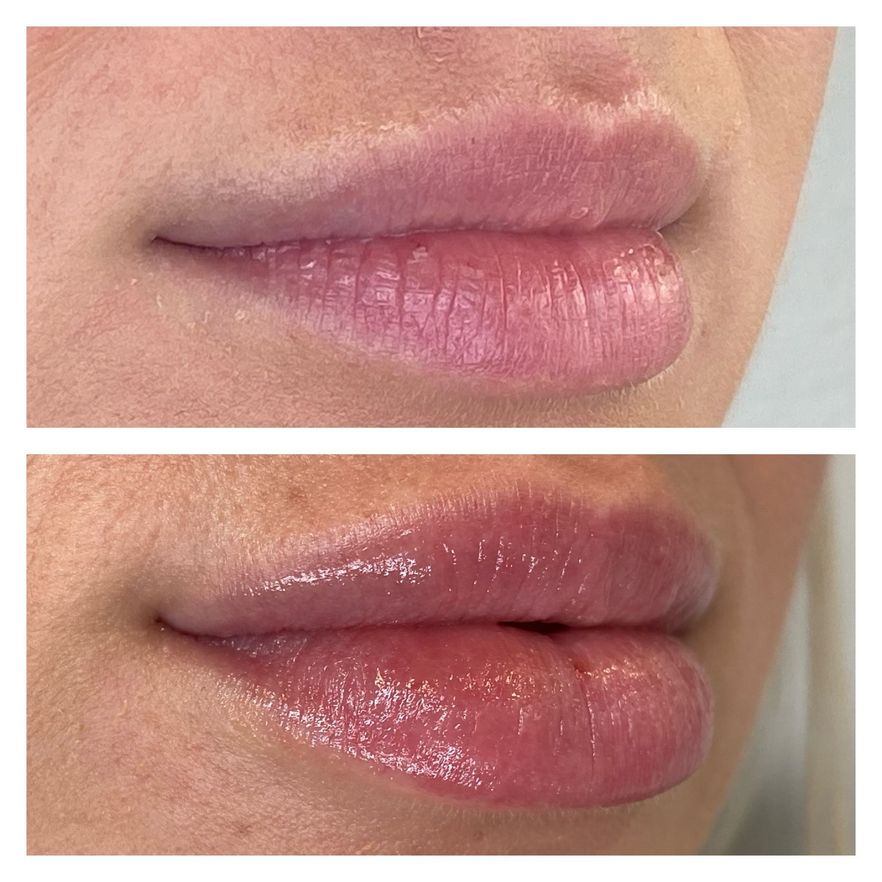 Before & After Lip Filler